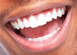 ZOOM! TEETH WHITENING TREATMENT – YOUR BURLINGTON COSMETIC DENTIST EXPLORES THE BENEFITS